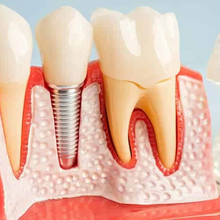 implantes-dentales-en-Clinica-Dental-Benicasim